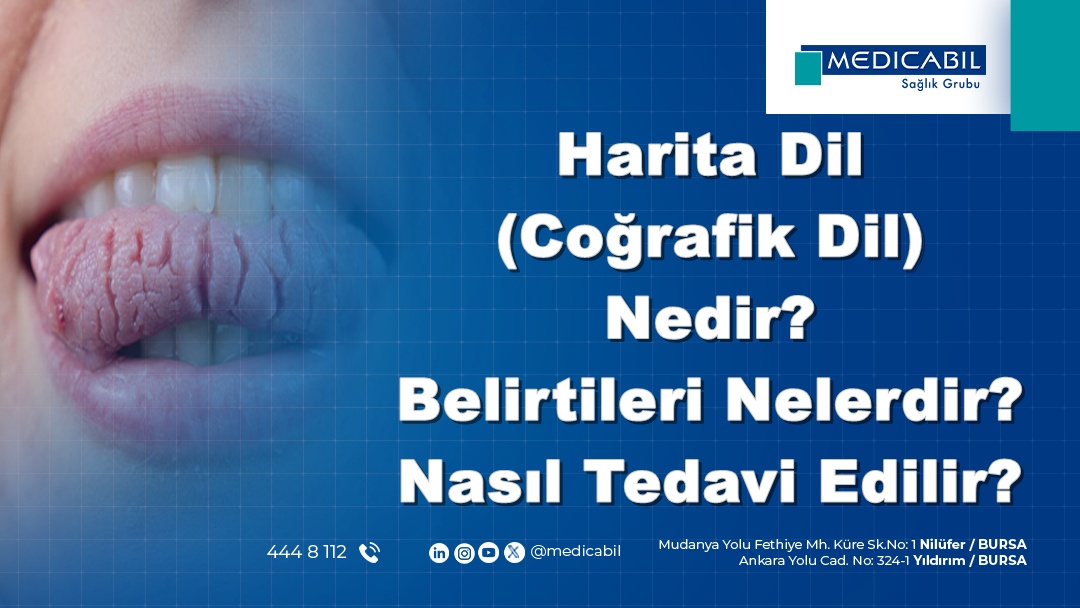 Harita Dil (Coğrafik Dil) Nedir? Belirtileri Nelerdir? Nasıl Tedavi ...