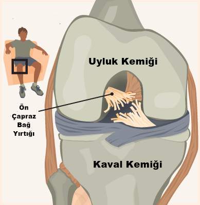  &Ouml;n &Ccedil;apraz Bağ Yırtığı