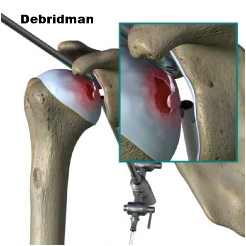 Debridman