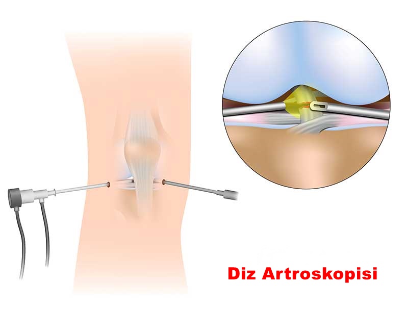 Diz Artroskopisi