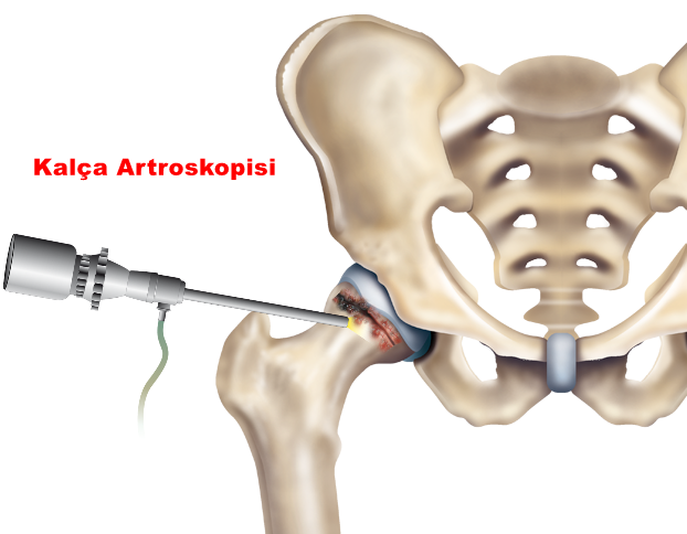  Kal&ccedil;a Artroskopisi
