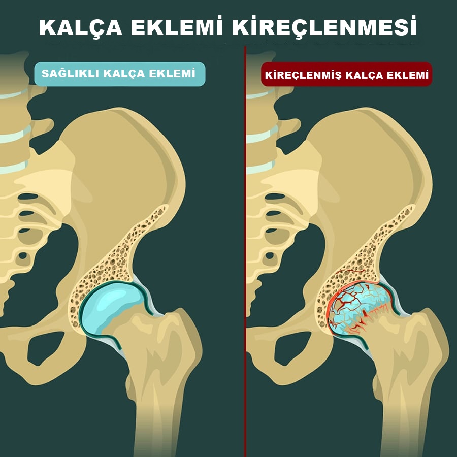 Kal&ccedil;a kire&ccedil;lenmesi