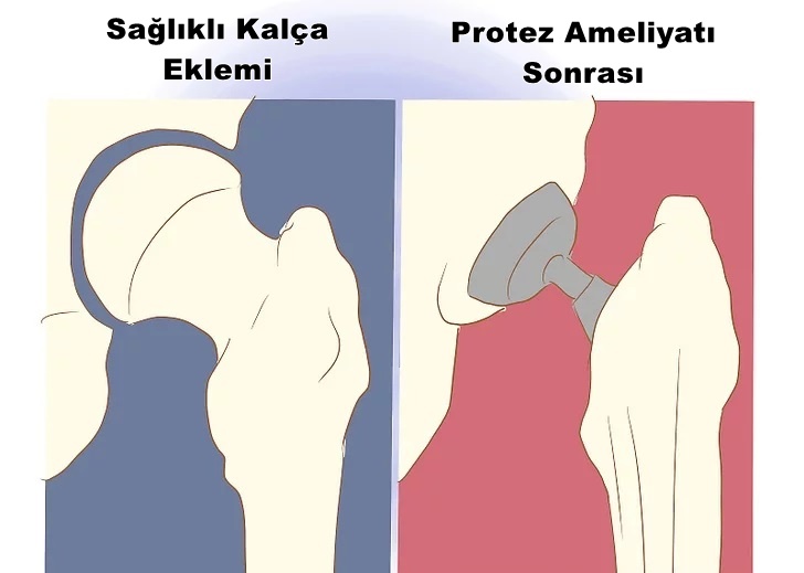 Kalpa Protezi Ameliyatı &Ouml;ncesi Sonrası