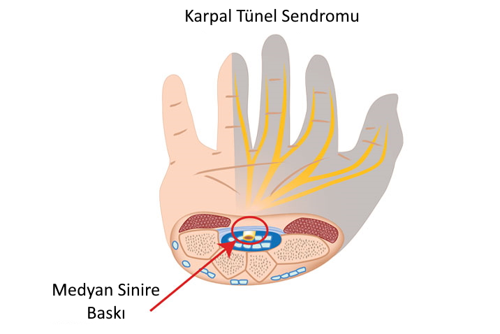  karpal t&uuml;nel sendromu medyan sinire baskı