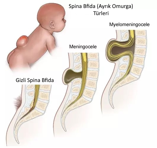 Ayrık Omurga Spina Bfida T&uuml;rleri