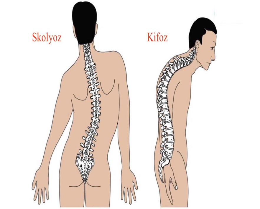  Skolyoz ile kifozun farkı