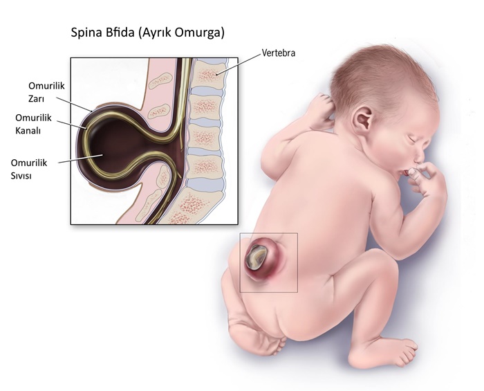Spinal Bfida Ayrık Omurga	