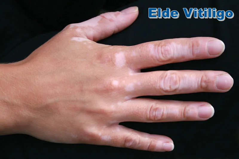 Elde Vitiligo